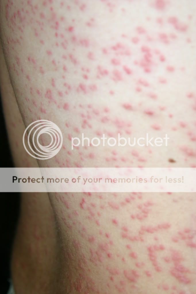 HELP ASAP Chiggers!!!